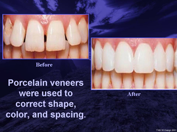 Dental Veneers. Beverly Hills Dentist