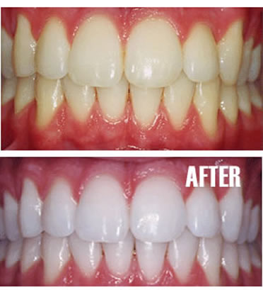 Dental Scaling and Root Planning