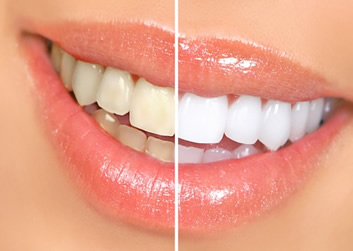 Whitening For Life Z Dental Group Los Angeles